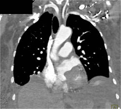 Lung Cancer Invades the Left Atrium - CTisus CT Scan