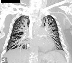Spm in Right Lower Lung - CTisus CT Scan