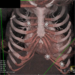 Normal Cartilage and Ribs in 3D - CTisus CT Scan
