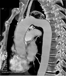 Aneurysm Off the Arch - CTisus CT Scan