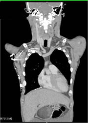 Collaterals Over the Chest Wall Due to Innominate Vein Stenosis - CTisus CT Scan