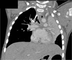 Occlusion of Left Upper Lung Due to Mucus Plugging - CTisus CT Scan