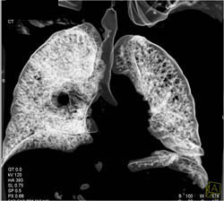 Lymphoma Infiltrates the Lung - CTisus CT Scan