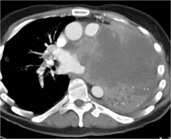 Lung Carcinoma Invades the Left Atrium - CTisus CT Scan