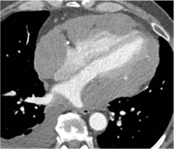 Cardiac Angiosarcoma - CTisus CT Scan