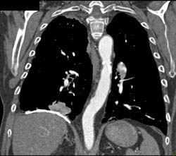 Pseudotumor Due to Asbestos With Pleural and Diaphragmatic Plaques - CTisus CT Scan