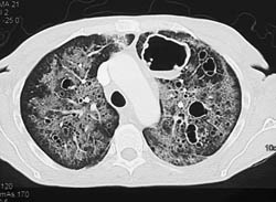 Cystic Fibrosis - CTisus CT Scan