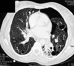 Klippel-Trenaunay-Weber (KTW) Syndrome With Lung Cysts and Splenic Hemangiomas With Left Pneumothorax - CTisus CT Scan