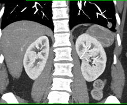 Left Lower Lung Nodule - CTisus CT Scan
