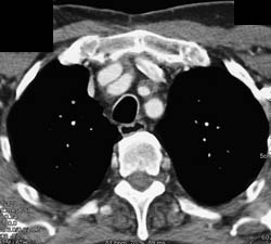 Plaque in Left Carotid Artery - CTisus CT Scan