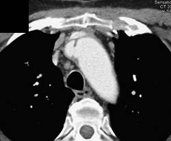 Type A Dissection - CTisus CT Scan