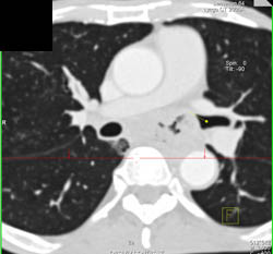 Lung Cancer Narrows Left Mainstem Bronchus - CTisus CT Scan