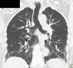 Bronchiectasis - CTisus CT Scan