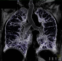 Bronchiectasis - CTisus CT Scan