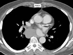 Bronchogenic Cyst - CTisus CT Scan