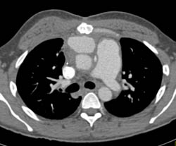 Pseudoaneurysm of Ascending Aorta- Type A - CTisus CT Scan