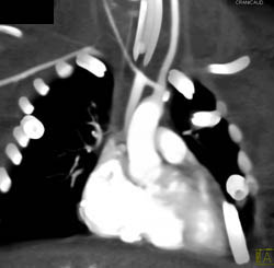 Patent Blalock-taussig Shunt- Modified - CTisus CT Scan