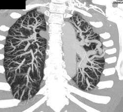 Pulmonary Arteriovenous Malformation (PAVM) - CTisus CT Scan