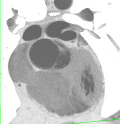 Dilated Aortic Root - CTisus CT Scan