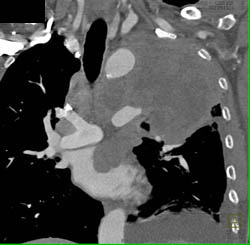 Lung Cancer Invades the Left Atrium - CTisus CT Scan