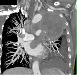 Lung Cancer Invades the Left Atrium - CTisus CT Scan