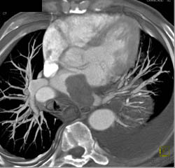 Lung Cancer Invades the Left Atrium - CTisus CT Scan