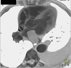 Lung Cancer Invades the Left Atrium - CTisus CT Scan