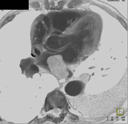 Lung Cancer Invades the Left Atrium - CTisus CT Scan