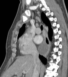 Bronchogenic Cyst - CTisus CT Scan