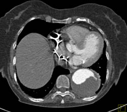 Dissection of Descending Aorta - CTisus CT Scan