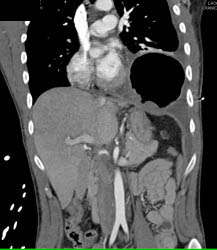 Herniation of Stomach Through Tear in Diaphragm. Stomach Was Ischemic at Surgery - CTisus CT Scan