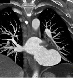 Aneurysm of Left Atrium - CTisus CT Scan