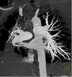 Pulmonary Artery Hypertension - CTisus CT Scan