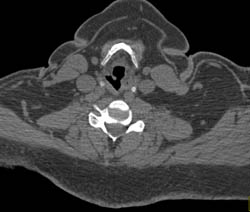 Lipoma of the Left Supraclavicular Zone - CTisus CT Scan