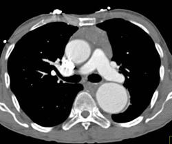 Thymoma - CTisus CT Scan
