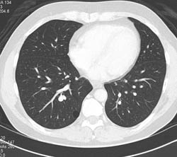 Bleb Right Lower Lung - CTisus CT Scan