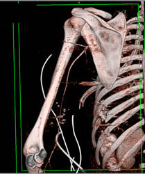 Gunshot to Chest With Spasm of Brachial Artery on CTA - CTisus CT Scan
