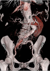 Type B Dissection - CTisus CT Scan