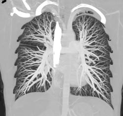 MIP of Lung - CTisus CT Scan