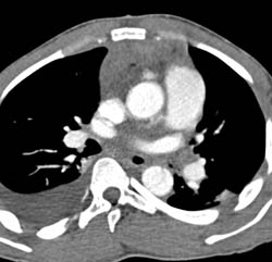 Aortic Root Repair and Dissection - CTisus CT Scan