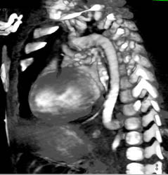 Tortuous Aorta Syndrome With Abdominal Aorta - CTisus CT Scan