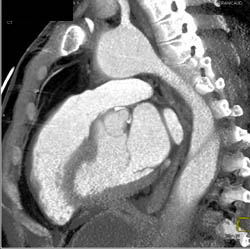 Aortic Dissection - CTisus CT Scan