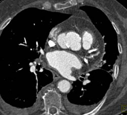 Pseudoaneurysm Compresses the SVC - CTisus CT Scan