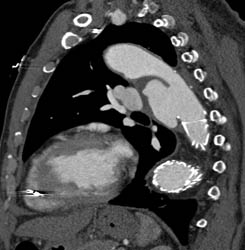 Repair of Dissection With Stent in Ulceration Above the Stent - CTisus CT Scan