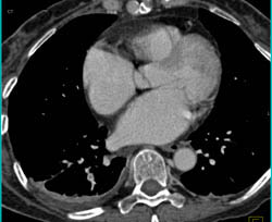 Pe - CTisus CT Scan