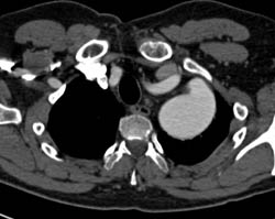 Ectatic Aorta Arch That Is Also High in Position - CTisus CT Scan