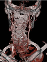 Ectatic Carotid Artery in Loeys-Dietz Syndrome - CTisus CT Scan