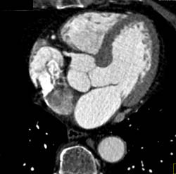Normal Aortic Root and Valve - CTisus CT Scan