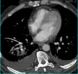 Pulmonary Embolism (PE) in Right Lower Lung - CTisus CT Scan