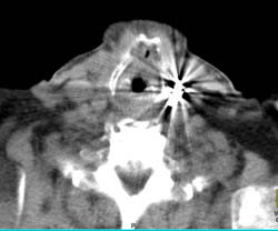 Recurrent Anaplastic Thyroid Cancer- PET/CT - CTisus CT Scan